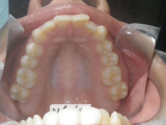Orthodontics: Case 38 - Before