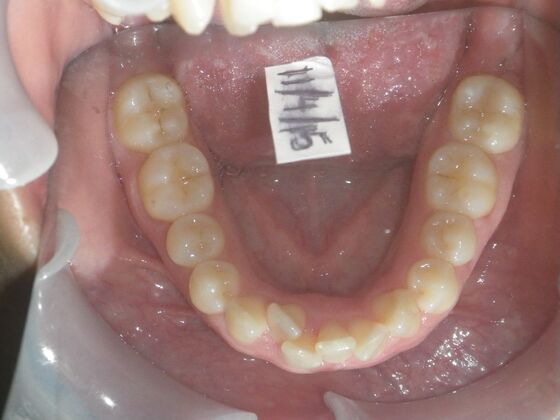 Orthodontics: Case 38 - Before