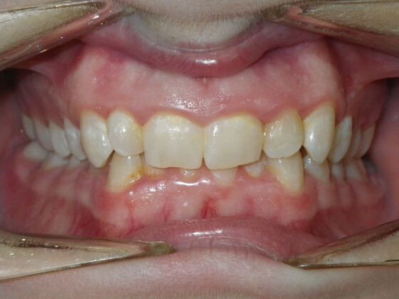 Orthodontics: Case 39 - Before