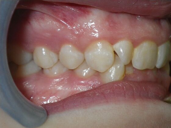 Orthodontics: Case 39 - Before