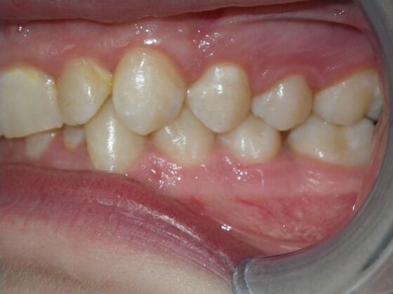 Orthodontics: Case 39 - Before