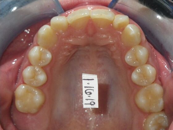Orthodontics: Case 39 - Before