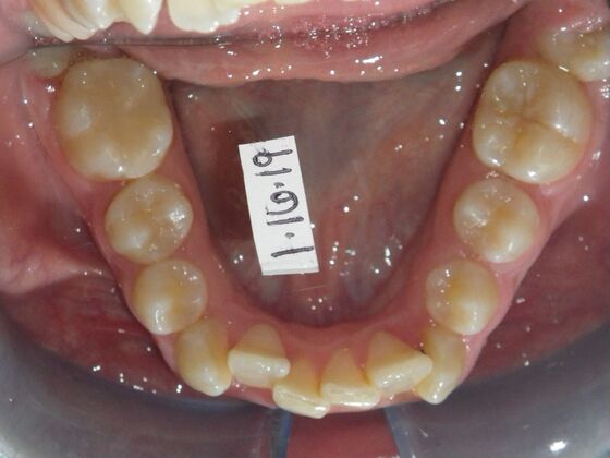 Orthodontics: Case 39 - Before