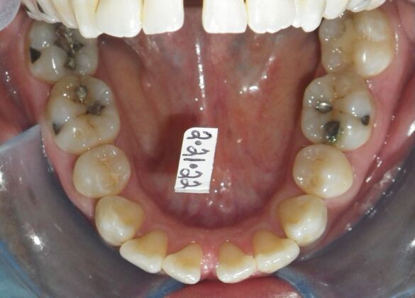 Orthodontics: Case 40 - Before