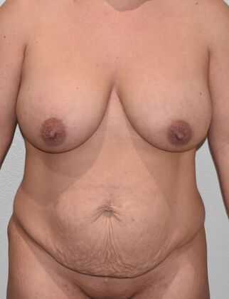 Mommy Makeover Case 262 - Before