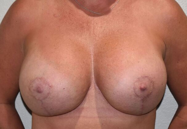 Breast Revision: Case 211 - After