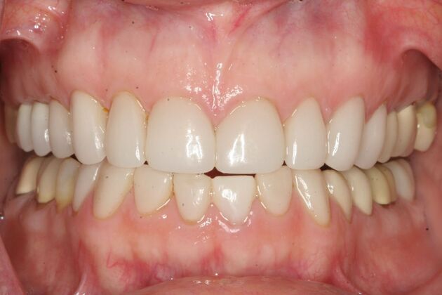            Dental Crowns Case 2 - Before