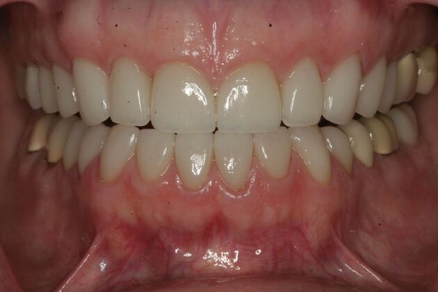           Dental Crowns Case 2 - After