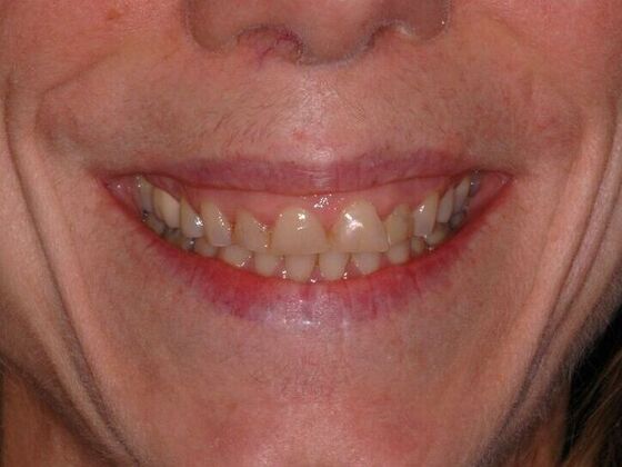 Full Mouth Reconstruction Case 1 - Before