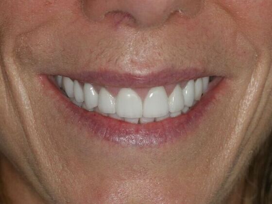 Full Mouth Reconstruction Case 1 - After