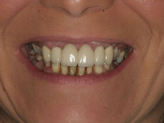 All-on-4 Dental Implants Case 4: Ridgewood, NJ - Before