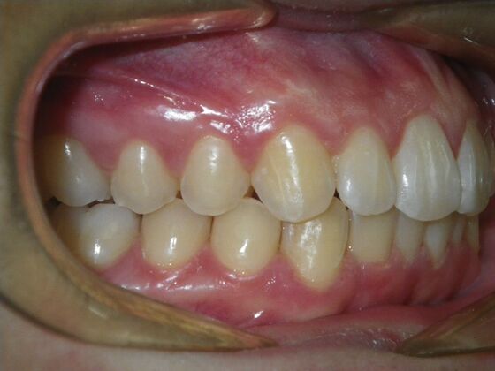 Invisalign: Case 15 - After