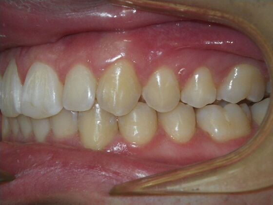 Invisalign: Case 15 - After