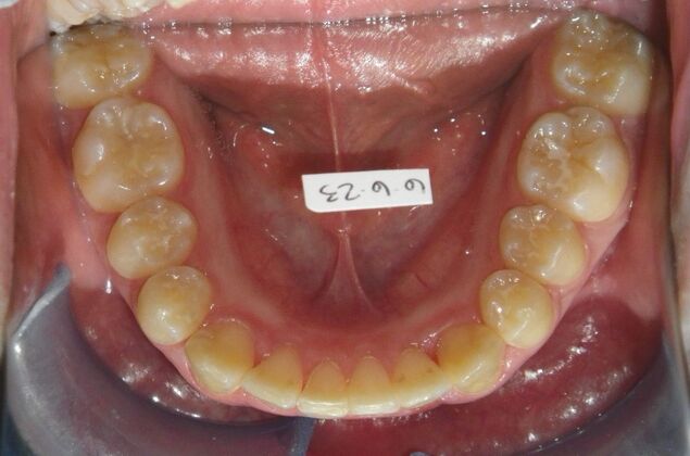 Invisalign: Case 15 - After
