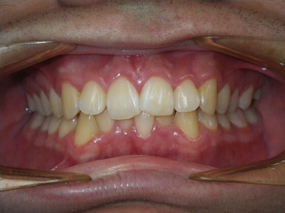 Invisalign: Case 15 - Before