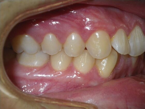 Invisalign: Case 15 - Before