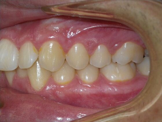 Invisalign: Case 15 - Before