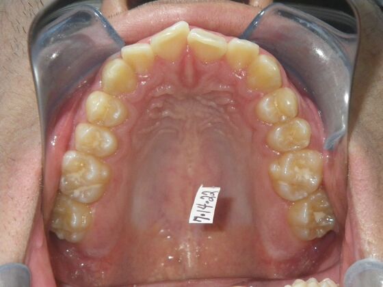 Invisalign: Case 15 - Before