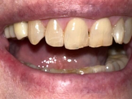 Dental Implants: Case 2 - After