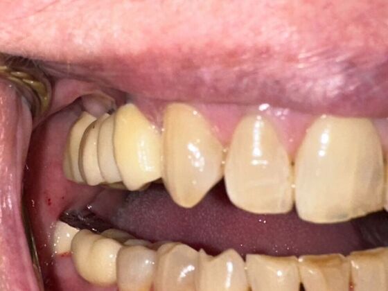 Dental Implants Case 2 - After