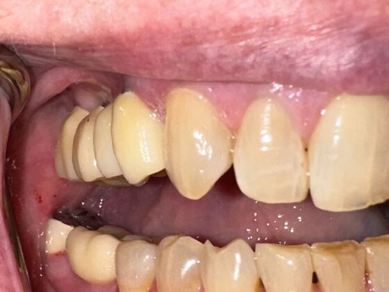 Dental Implants: Case 2 - After