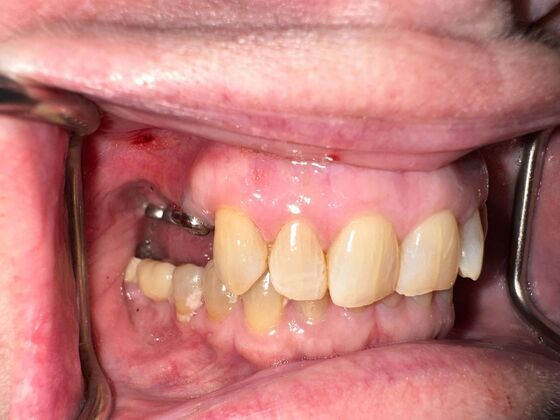 Dental Implants: Case 2 - Before
