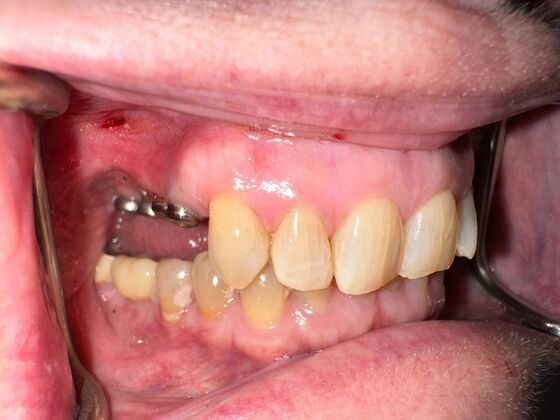Dental Implants Case 2 - Before