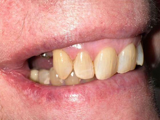 Dental Implants: Case 2 - Before