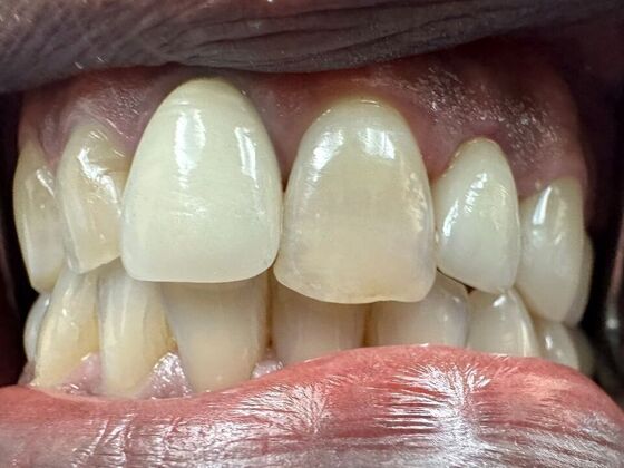 Dental Crowns Case 1 - After