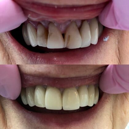 Click Here to See More Before & After Photos Dental Crown 8