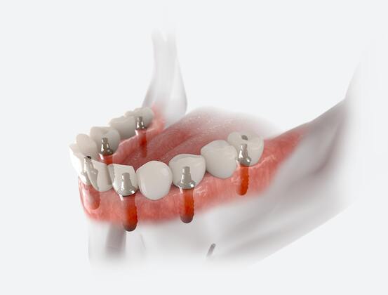 Dental Implants Cases