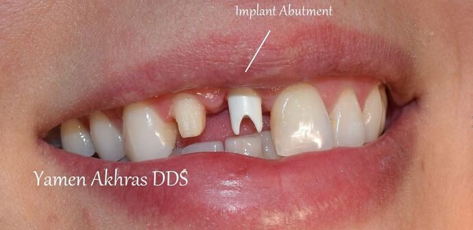 Dental Implants: Patient 2 - Before an Implant and Crown