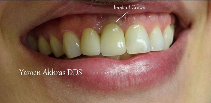 Dental Implants: Patient 2 - After an Implant and Crown