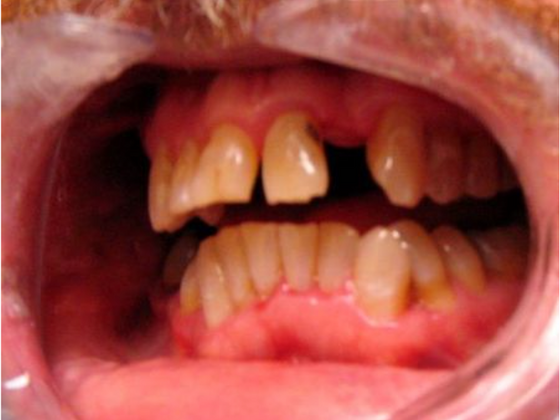 Smile Makeovers, actual cases of our dentists, no special lighting or editing Case 2 - Before