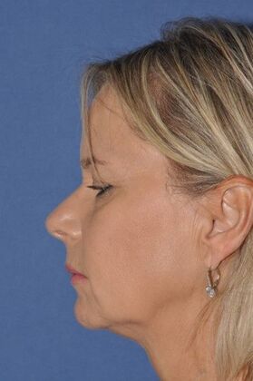 Facelift: Before and after full facial rejuvenation - Before