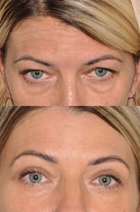 Eyelid Surgery Upper lid blepharoplasty