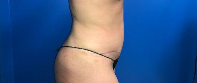 Abdominoplasty: Case 31 - After