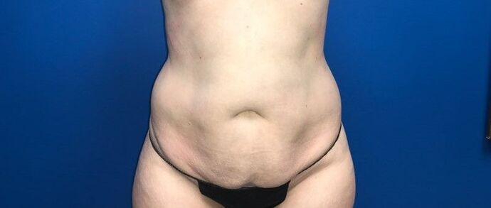 Abdominoplasty: Case 31 - Before