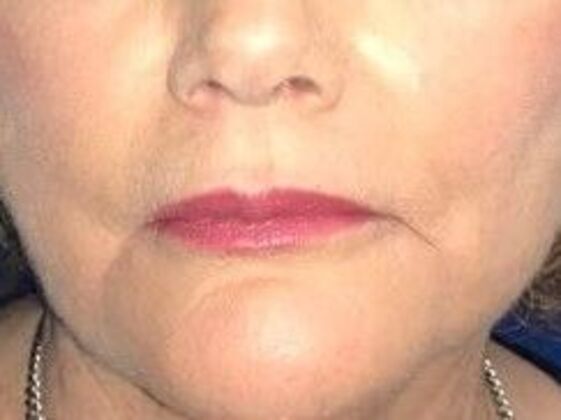 Cosmetic Injectables & Fillers Case 2 - After