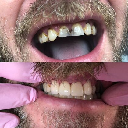 Click Here to See More Before & After Photos Dental Crown 9