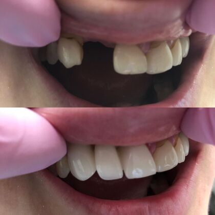 Click Here to See More Before & After Photos Bridge 