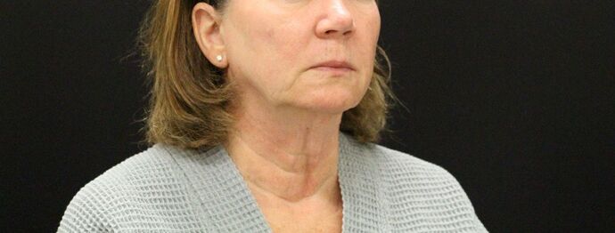 Face & Neck Lifts: Case 9 - Before