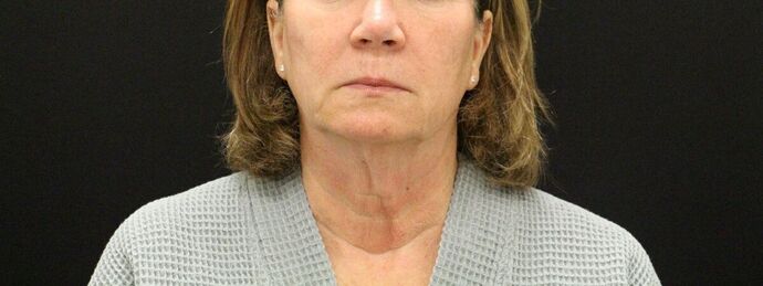 Face & Neck Lifts Case 9 - Before