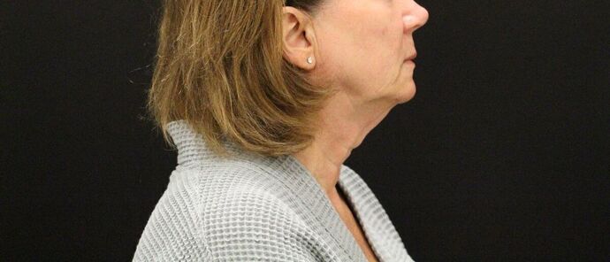 Face & Neck Lifts: Case 9 - Before