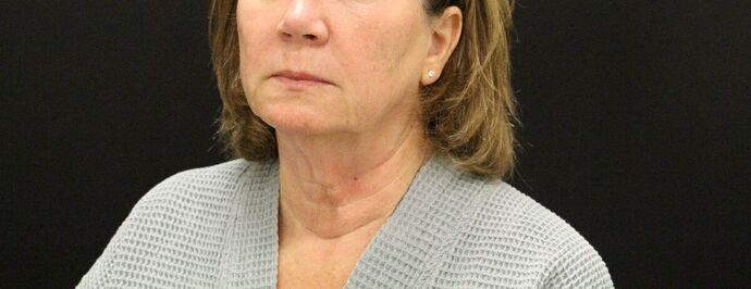 Face & Neck Lifts: Case 9 - Before