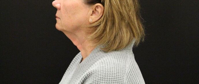 Face & Neck Lifts: Case 9 - Before