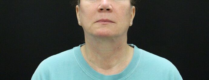 Face & Neck Lifts Case 9 - After