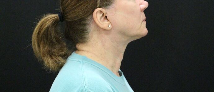 Face & Neck Lifts: Case 9 - After