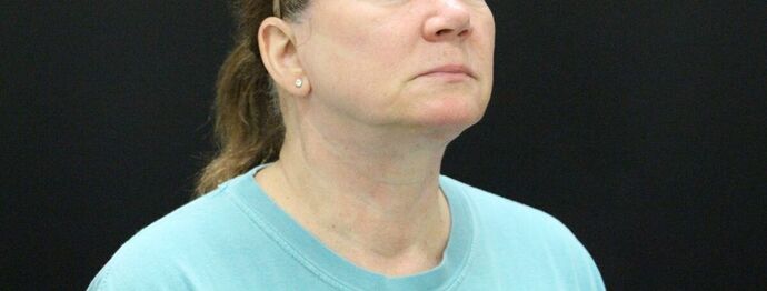 Face & Neck Lifts: Case 9 - After