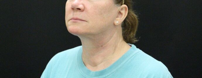 Face & Neck Lifts: Case 9 - After